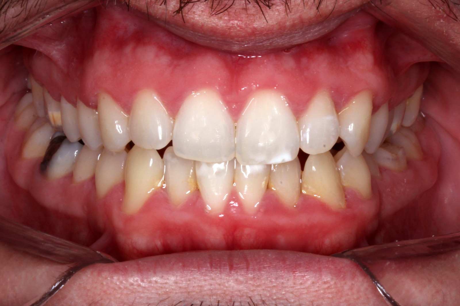 Antes del tratamiento con alineadores invisibles en Buenos Aires - caso 1