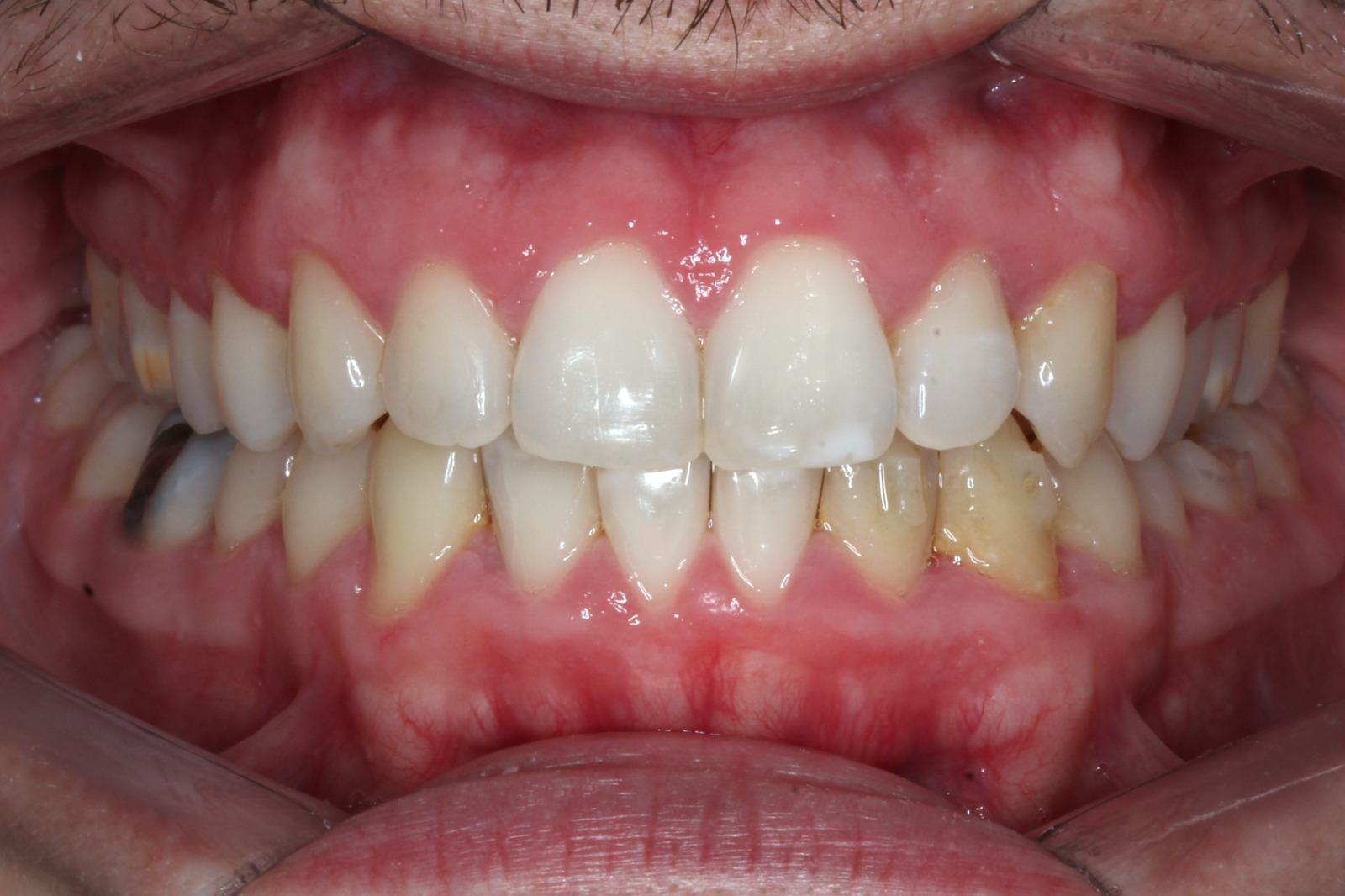 Despues del tratamiento con alineadores invisibles en Buenos Aires - caso 1