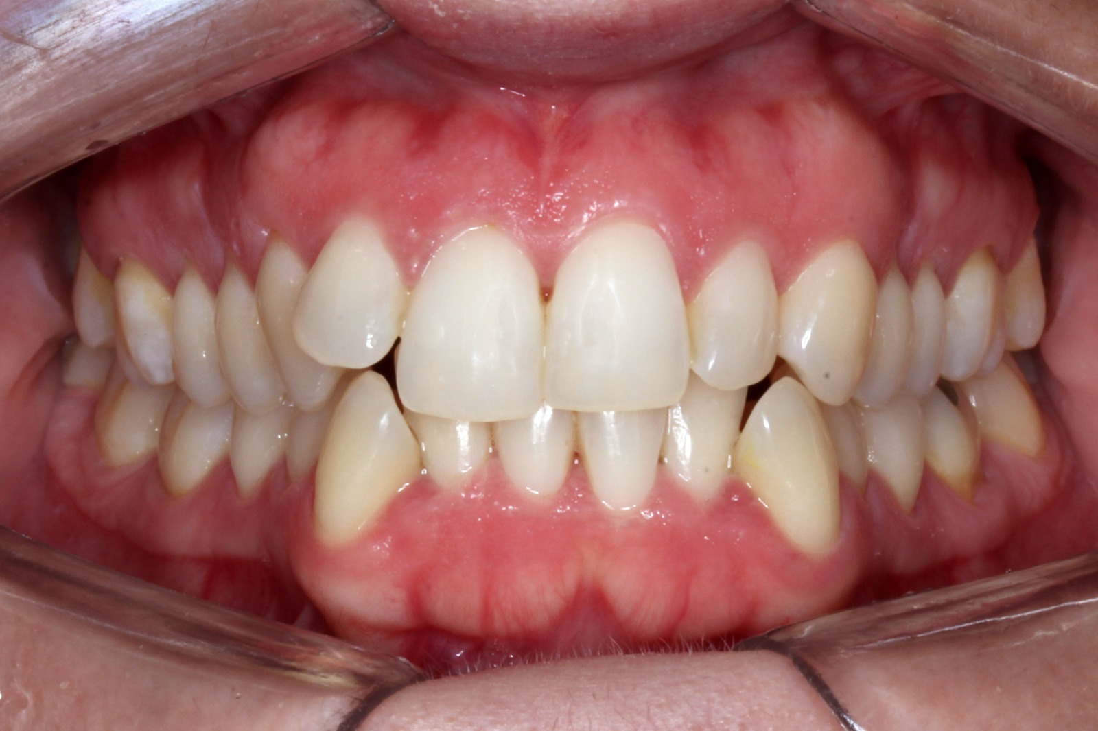 Antes del tratamiento con alineadores invisibles - caso 1