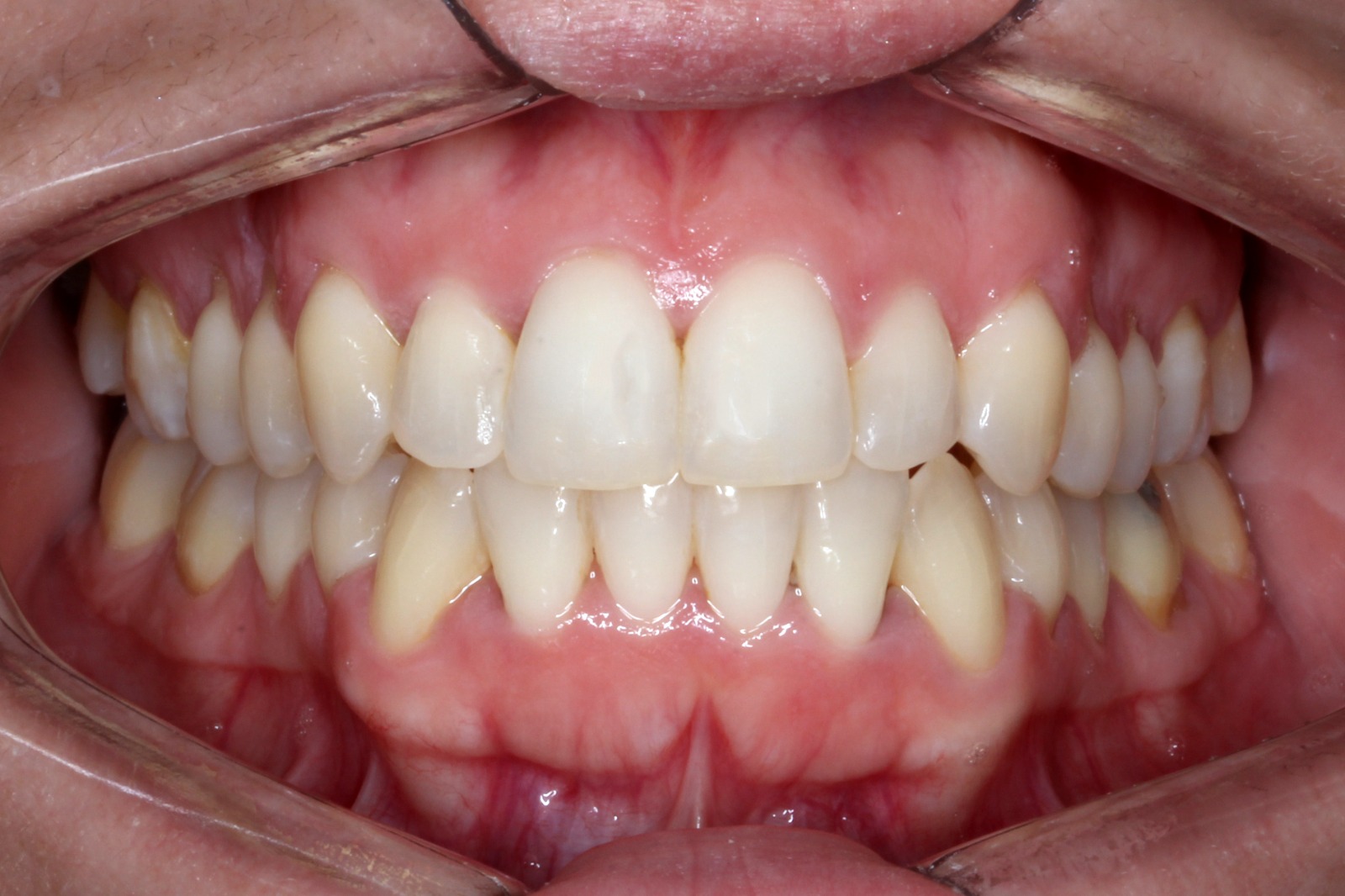 Despues del tratamiento con alineadores invisibles - caso 1