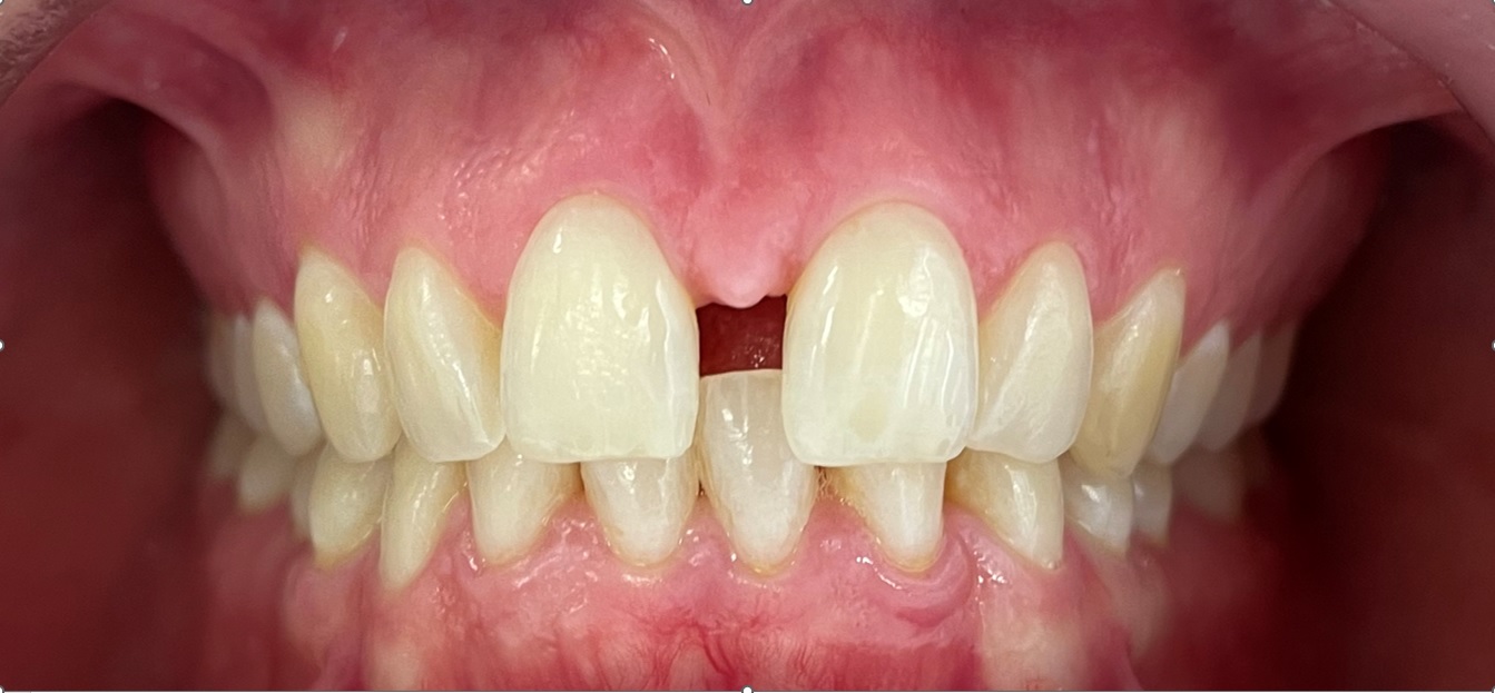 Antes del tratamiento con alineadores invisibles - caso 2