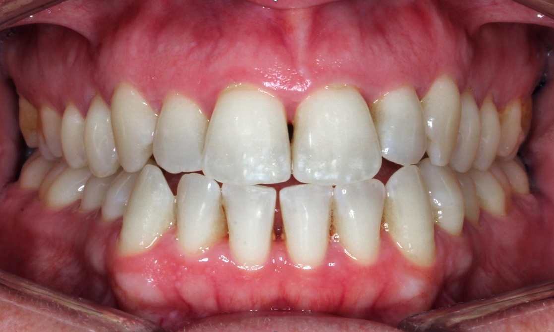 Antes del tratamiento con alineadores invisibles