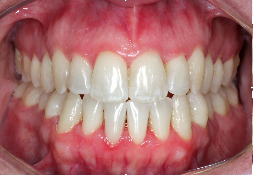 Despu&eacute;s del tratamiento con alineadores invisibles