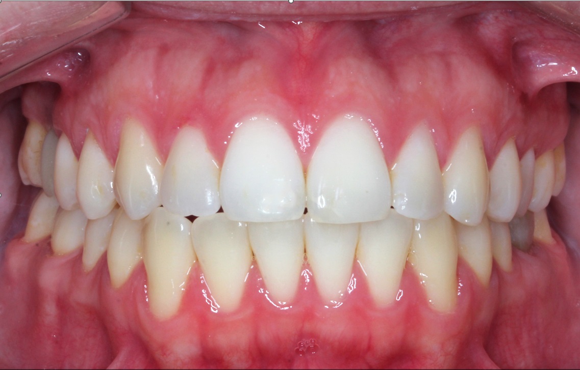 Antes del tratamiento con alineadores invisibles - caso 3