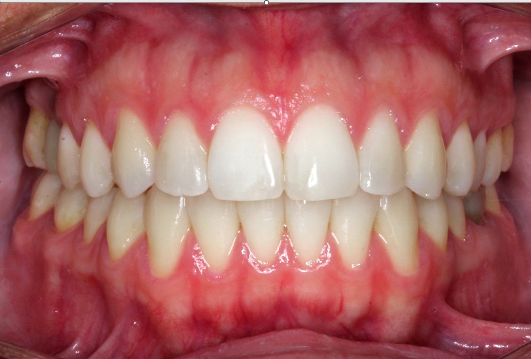 Despues del tratamiento con alineadores invisibles - caso 3